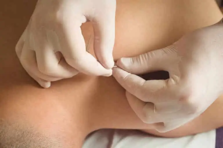 Lasting Pain Relief with Dry Needling in NYC
