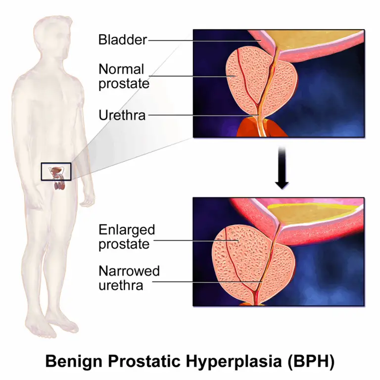 Benign Prostatic Hyperplasia: How Pelvic Floor Dry Needling Can Support Men with BPH