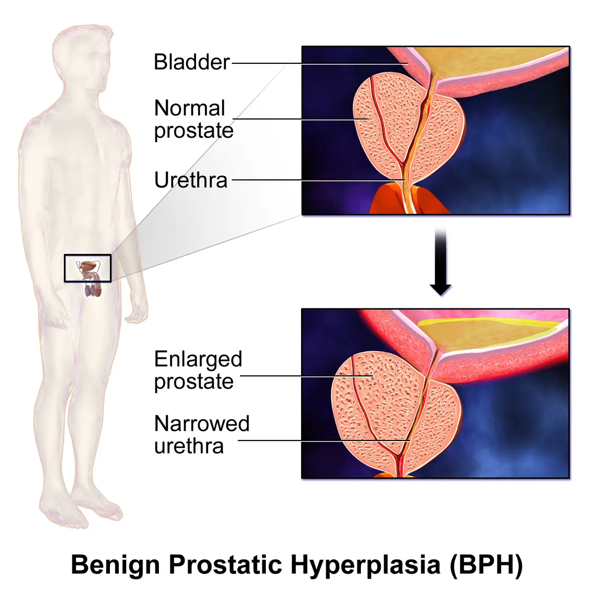 Benign Prostatic Hyperplasia (BPH)