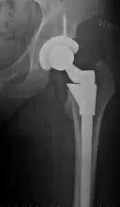 Hip Replacement Pain: How Dry Needling and Acupuncture Can Help Break the Cycle hip replacement