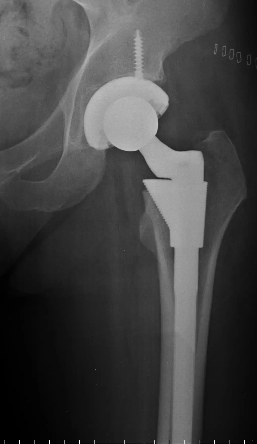 hip replacement