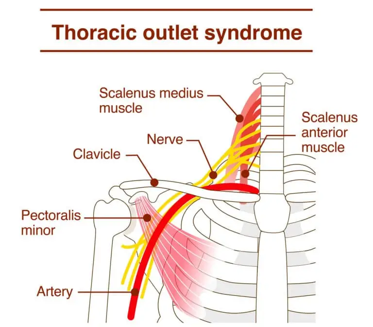What is Pectoralis Minor Syndrome?