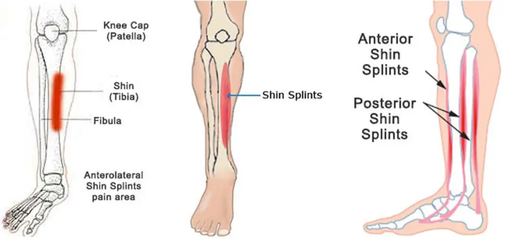 shin splint muscles