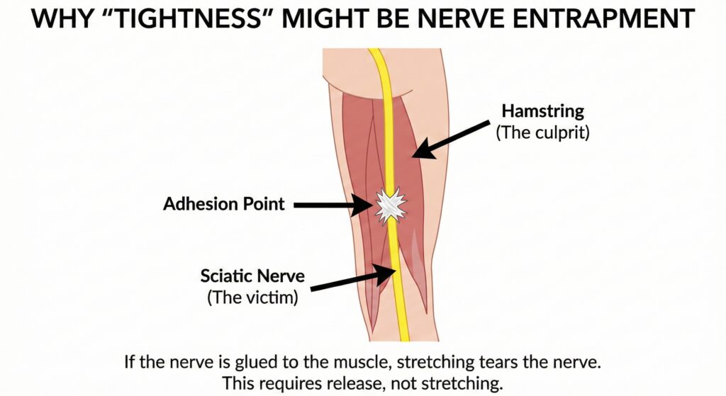 Nerve Entrapment in hamstring