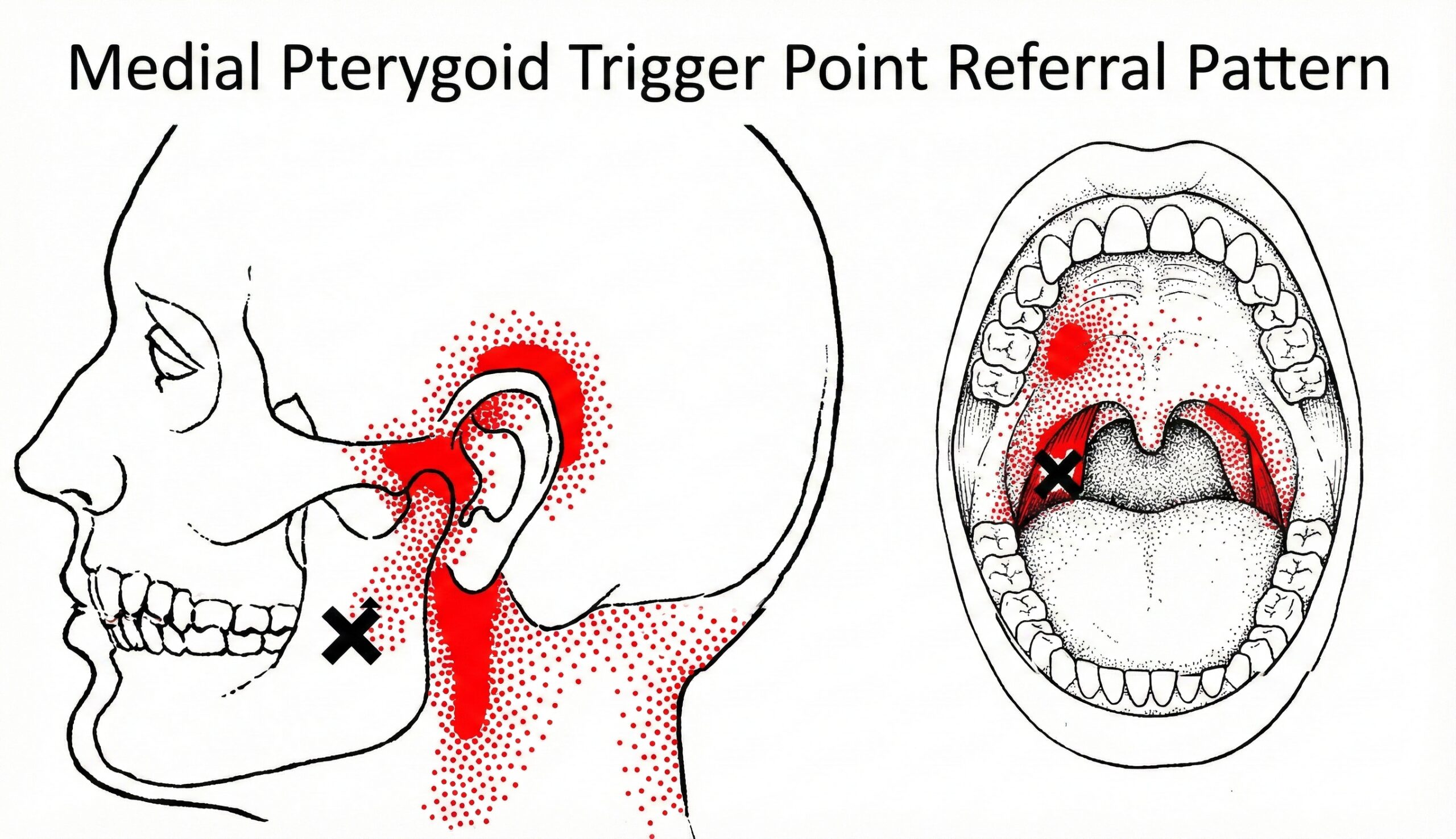 Medial Pterygoid Trigger Points: Referral Patterns, Assessment, and Safe Relief