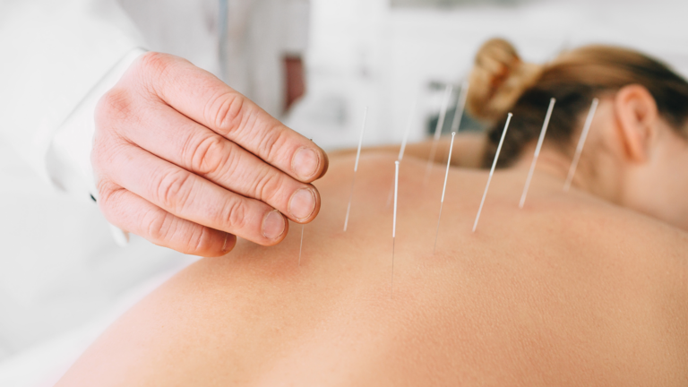 Acupuncture UWS