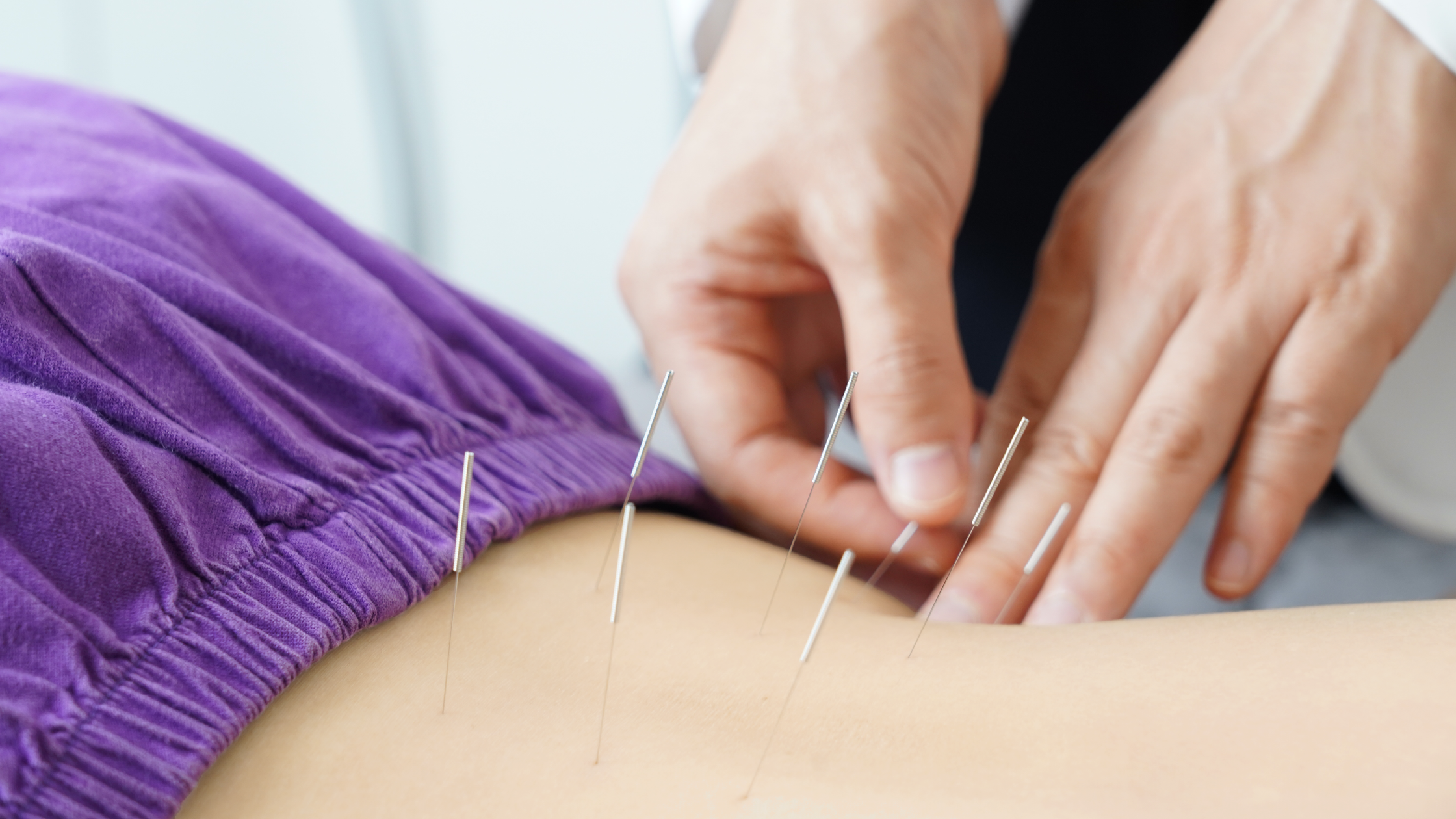 Dry Needling for Sciatica: How It Works and What to Expect