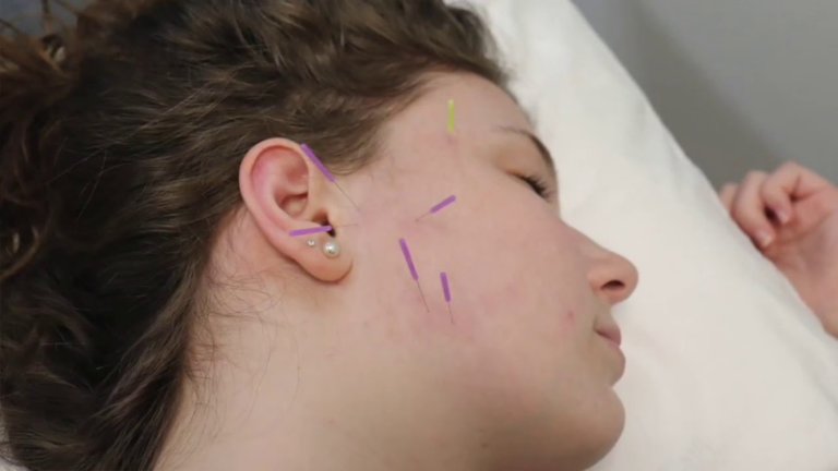 Dry Needling for TMJ for Muscle Tightness and Trigger Points