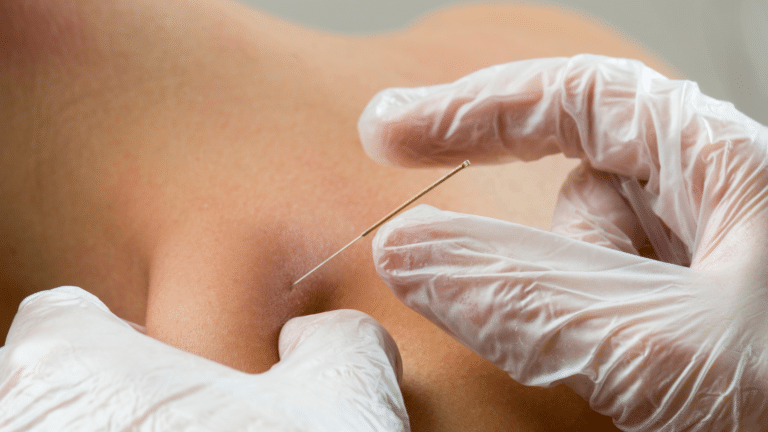 How Does Dry Needling on the Upper West Side, NYC, Help Relieve Chronic Muscle Pain?